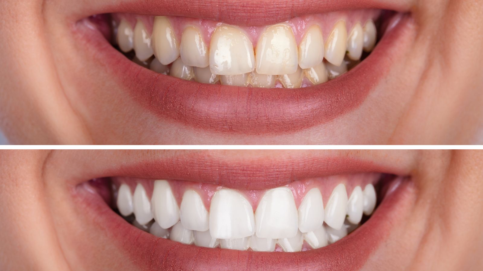 Risultato sbiancamento dentale Caserta