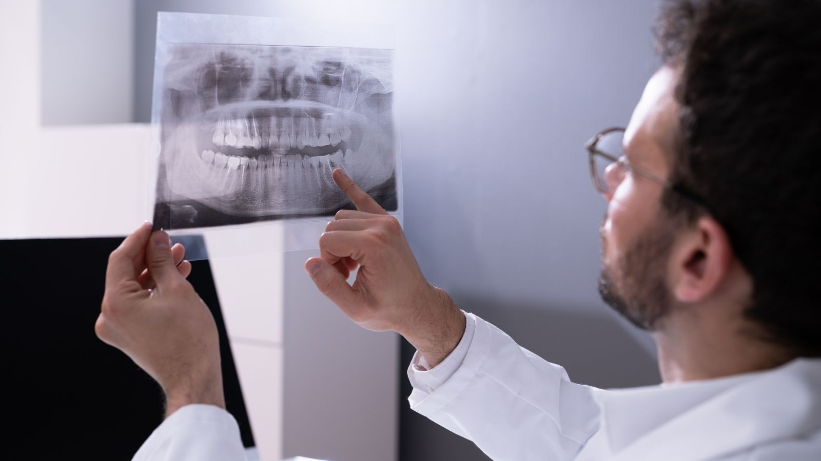 Denti del giudizio: quando diventano un problema e quando no