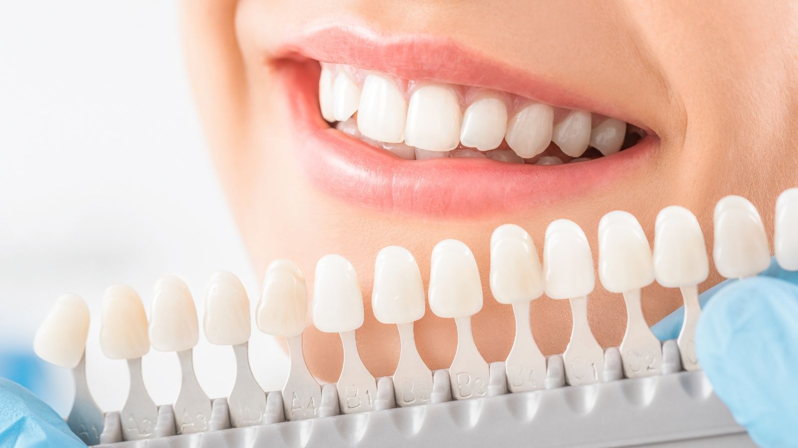 Sorriso naturale e armonioso: estetica dentale etica a Caserta