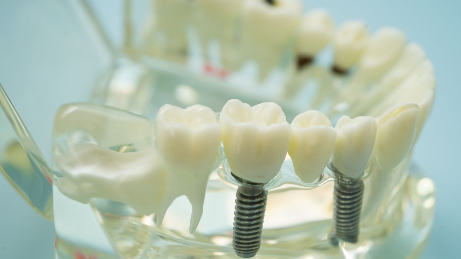Differenza tra ponte e impianto dentale: schema semplice