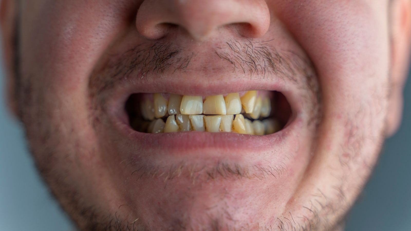 Macchie sui denti causate da caff&egrave; e fumo