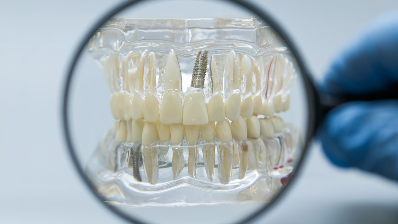 Meglio ponte o impianto? Scelta personalizzata al Dental Center Caserta