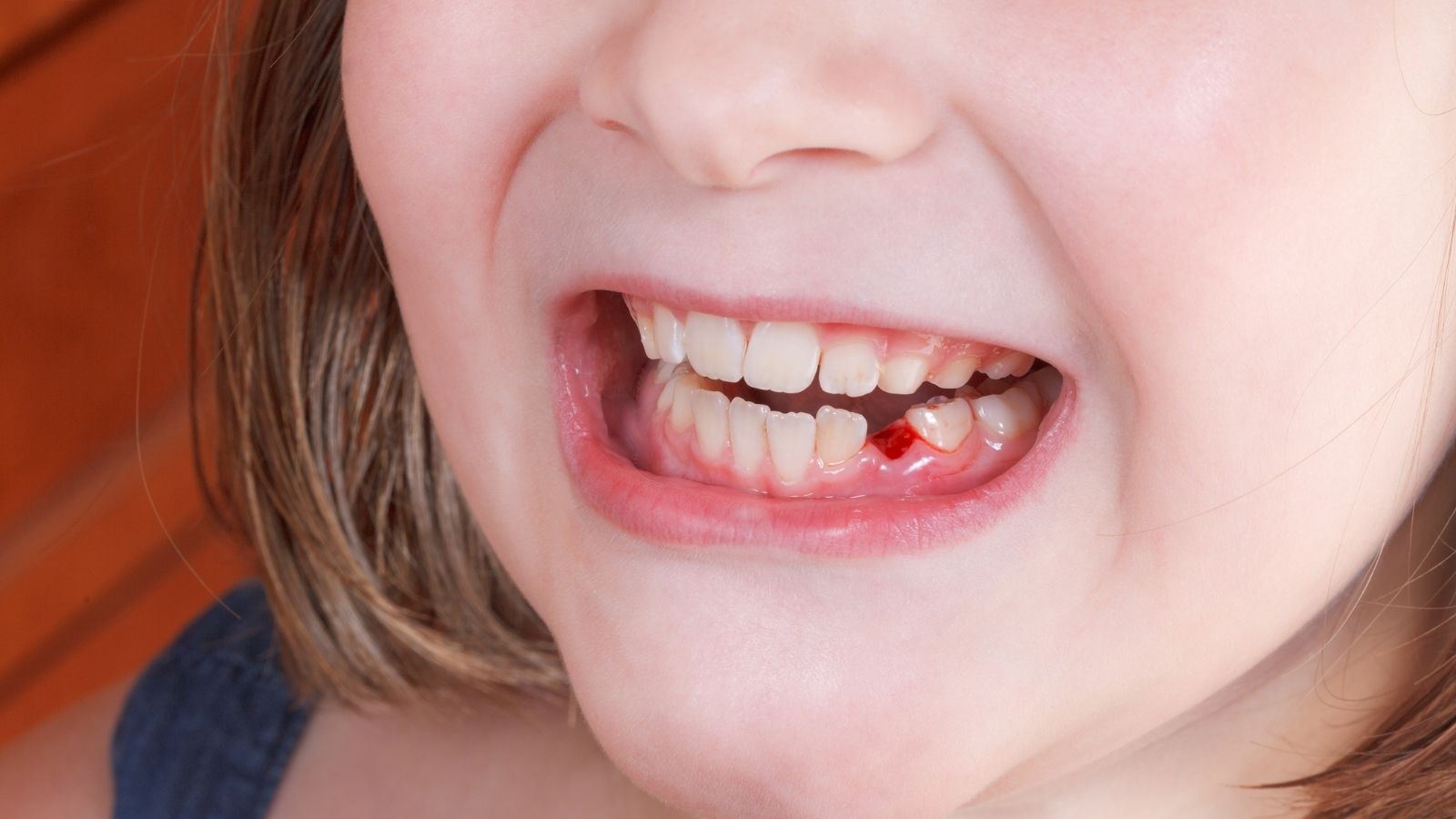 Come recuperare correttamente un dente caduto