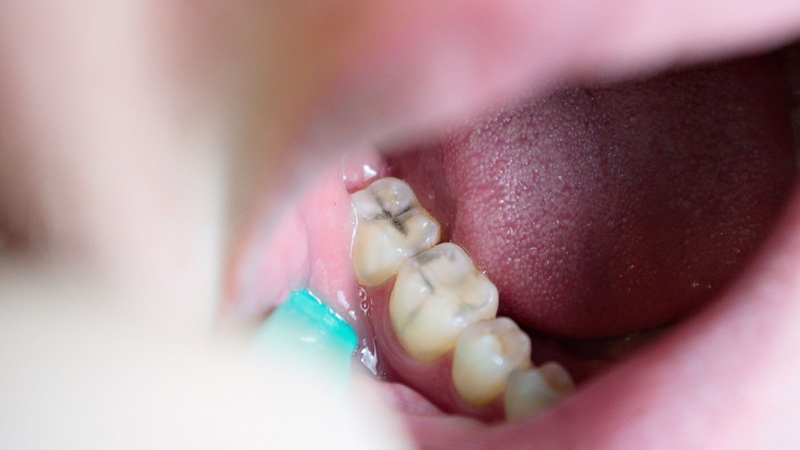 Denti consumati: &egrave; normale con il tempo?