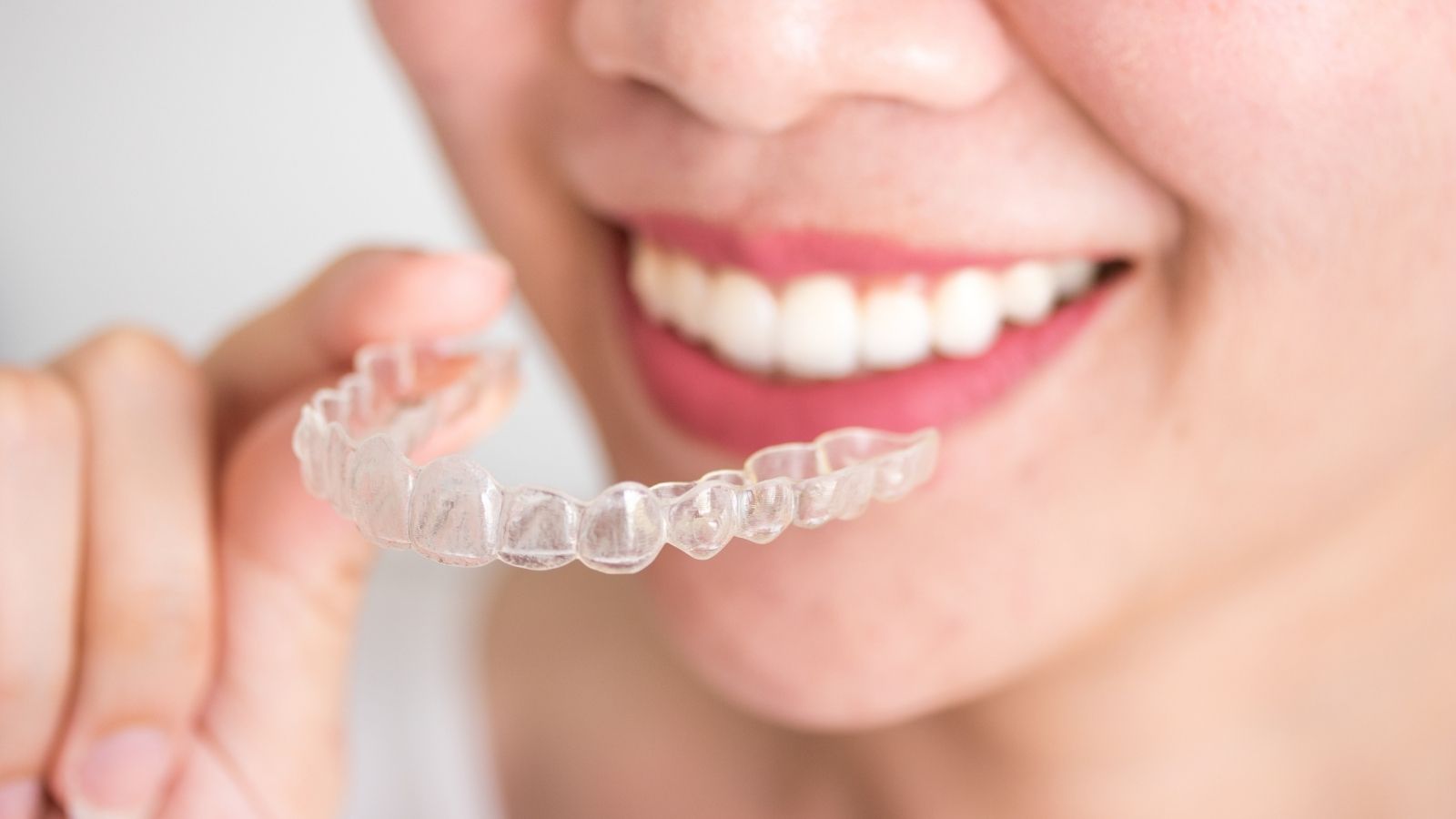 Trattamento Invisalign al Dental Center Caserta