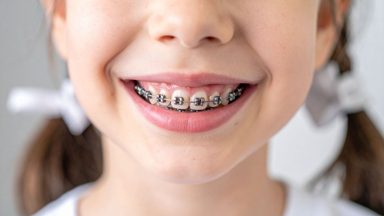 Gen Z e apparecchio ai denti: ortodonzia senza imbarazzo