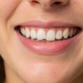 Dente scheggiato in vacanza: cosa fare subito