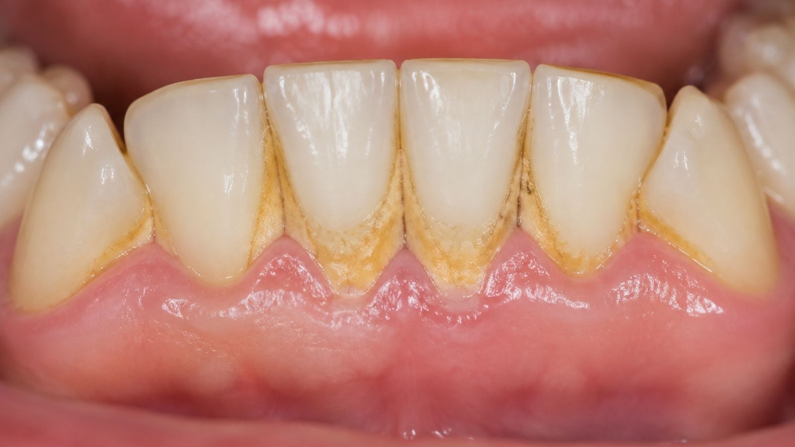 Differenza tra placca e tartaro sui denti